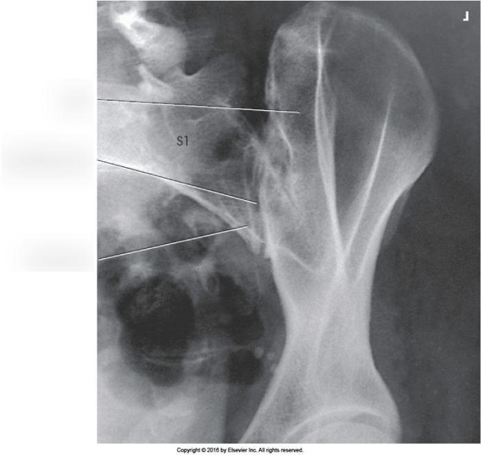 Si joint x ray oblique