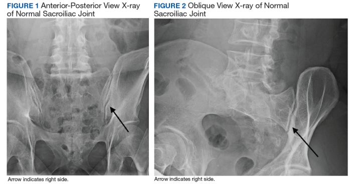 Si joint x ray oblique