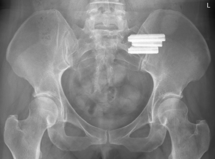 Sacroiliac slidesharedocs rays discrepancy interpretation