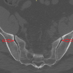 Joint sacroiliac ankylosing spondylitis rays diagnosis arrows bjchealth