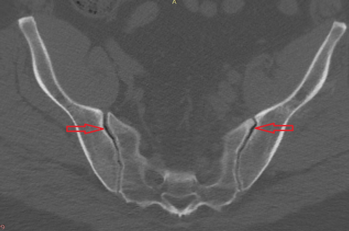 Joint sacroiliac ankylosing spondylitis rays diagnosis arrows bjchealth