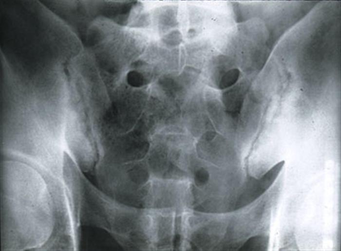 Sacroiliac dysfunction pelvis